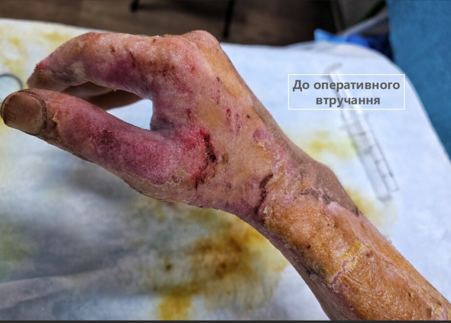 У міській лікарні Дніпра військовому відновили функцію кисті після тяжких опіків